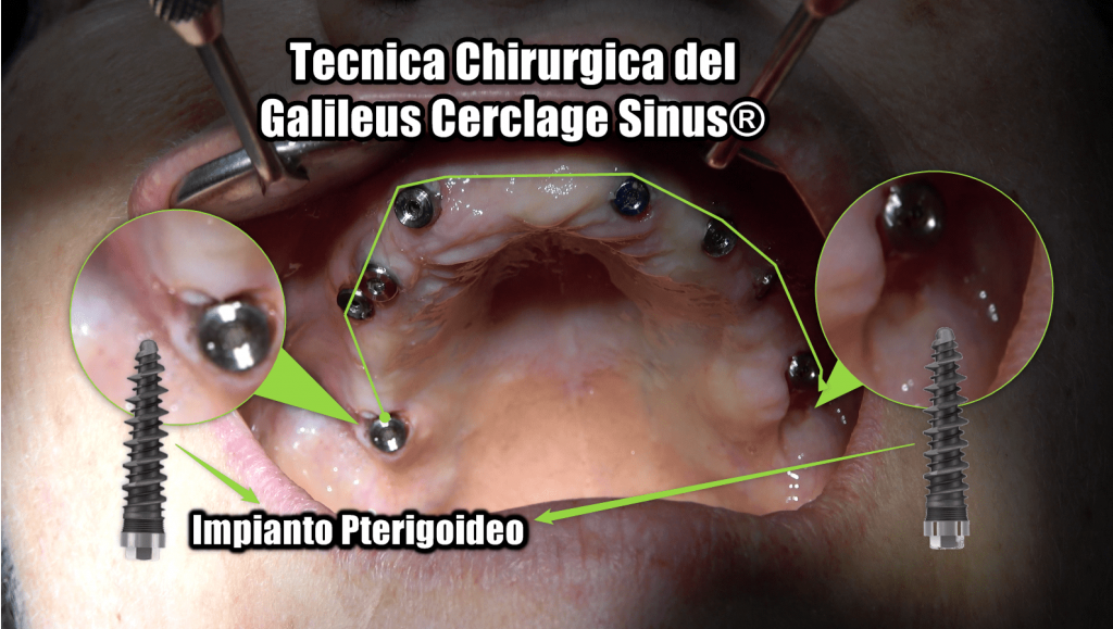 Galileus Cerclage Sinus®: The Innovative Solution for New York Patients without Bone