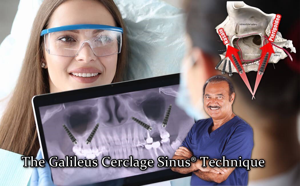 The Galileus Cerclage Sinus® Technique