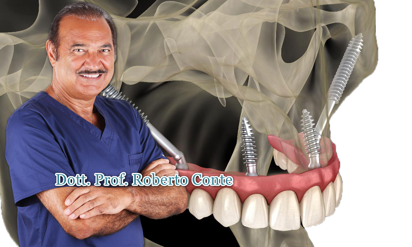 Dental Rebirth After Implant Failure: The Success Story of Mr. Bigi from Modena